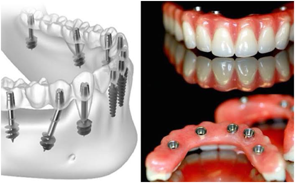 Dental implant and natural tooth side by side, promoting Dental Implants Treatment in Indore.